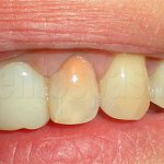 Зубы, леченные резорцин-формалиновым методом