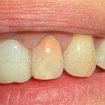 Teeth treated with resorcinol-formalin method