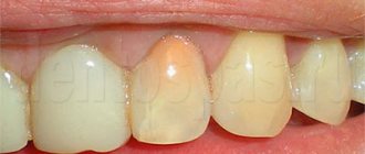 Teeth treated with resorcinol-formalin method